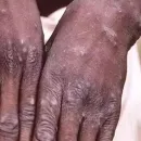 Emergency Declared in an African Country Due to Monkeypox Alert