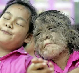 Eleven Babies Affected by Werewolf Syndrome Due to Minoxidil Use in Spain