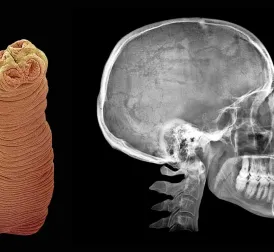 Shocking Incident of American Woman Ordering Tapeworm Eggs on Dark Web for Weight Loss