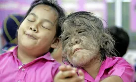 Eleven Babies Affected by Werewolf Syndrome Due to Minoxidil Use in Spain