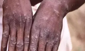 Emergency Declared in an African Country Due to Monkeypox Alert