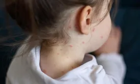 First Measles-Related Death in 10 Years in the US