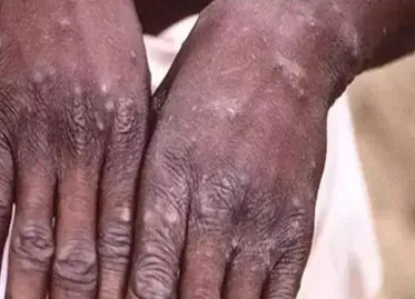 Emergency Declared in an African Country Due to Monkeypox Alert