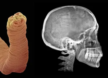 Shocking Incident of American Woman Ordering Tapeworm Eggs on Dark Web for Weight Loss