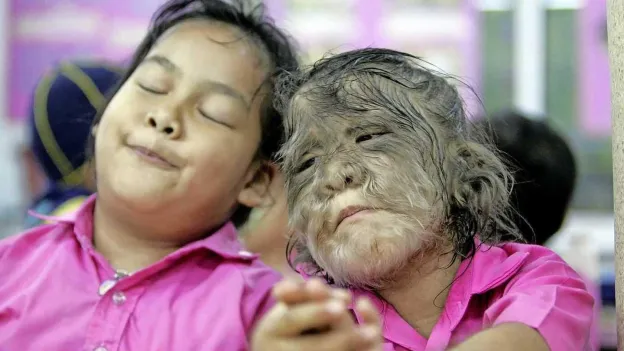 Eleven Babies Affected by Werewolf Syndrome Due to Minoxidil Use in Spain