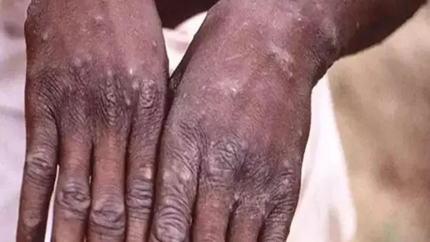 Emergency Declared in an African Country Due to Monkeypox Alert